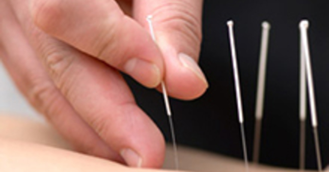 Acupuncture